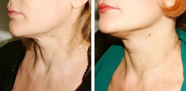 photo before and after laser skin rejuvenation 1