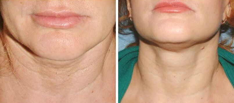 photo before and after laser skin rejuvenation 2