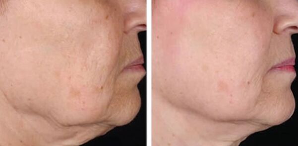 photo before and after laser skin rejuvenation 3