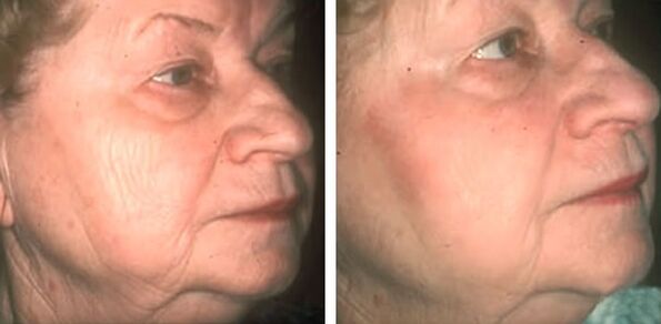 photo before and after laser skin rejuvenation 4