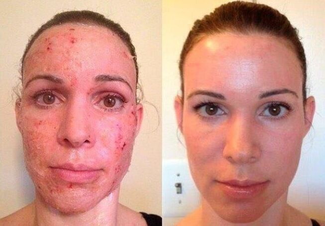 photo before and after partial skin rejuvenation 1