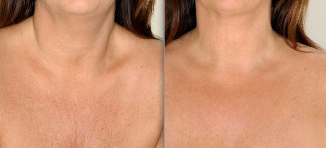 photos before and after partial skin rejuvenation 2