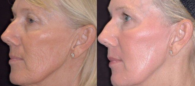 photos before and after partial skin rejuvenation 3