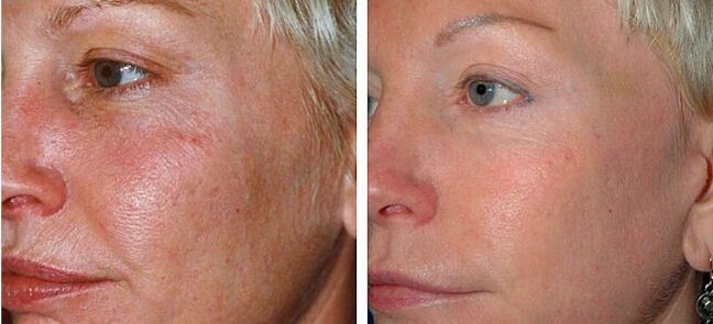 photos before and after partial skin rejuvenation 4