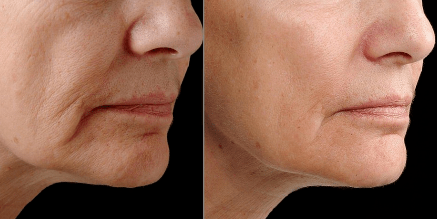 Laser fraction renewal - effect