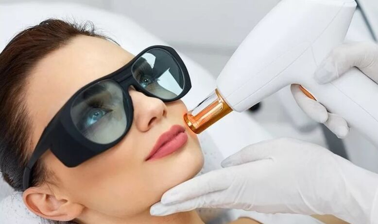 Laser renewal of the skin