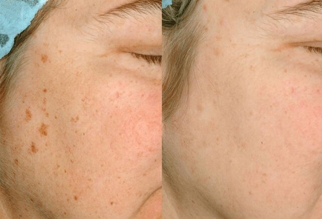 Removing pigmentation on the skin